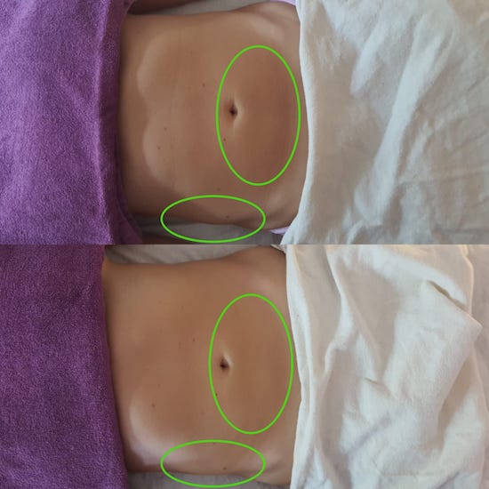 Brasilianische Lymphdrainage München Bauch Vorher Nachher Bilder