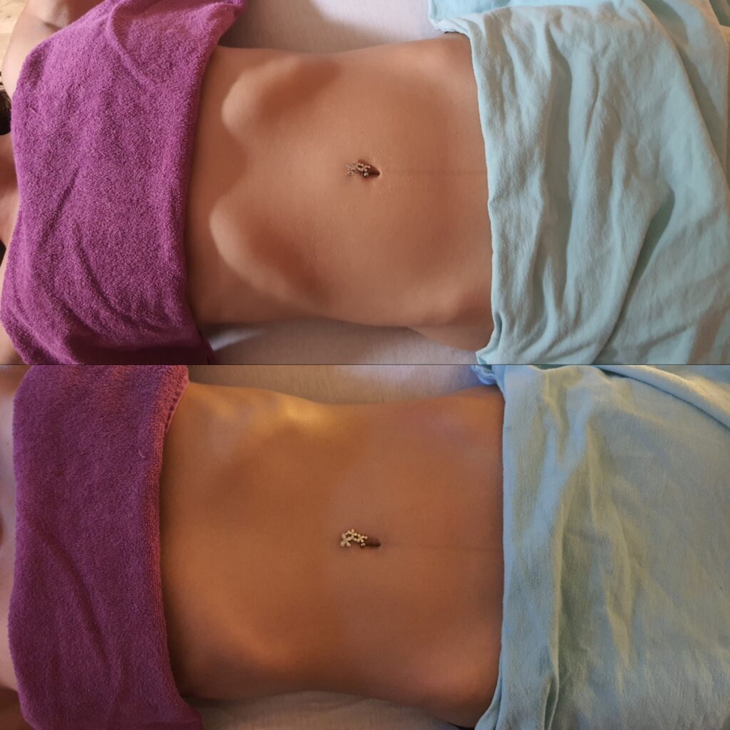 Brasilianische Lymphdrainage in München Vorhher Nachher