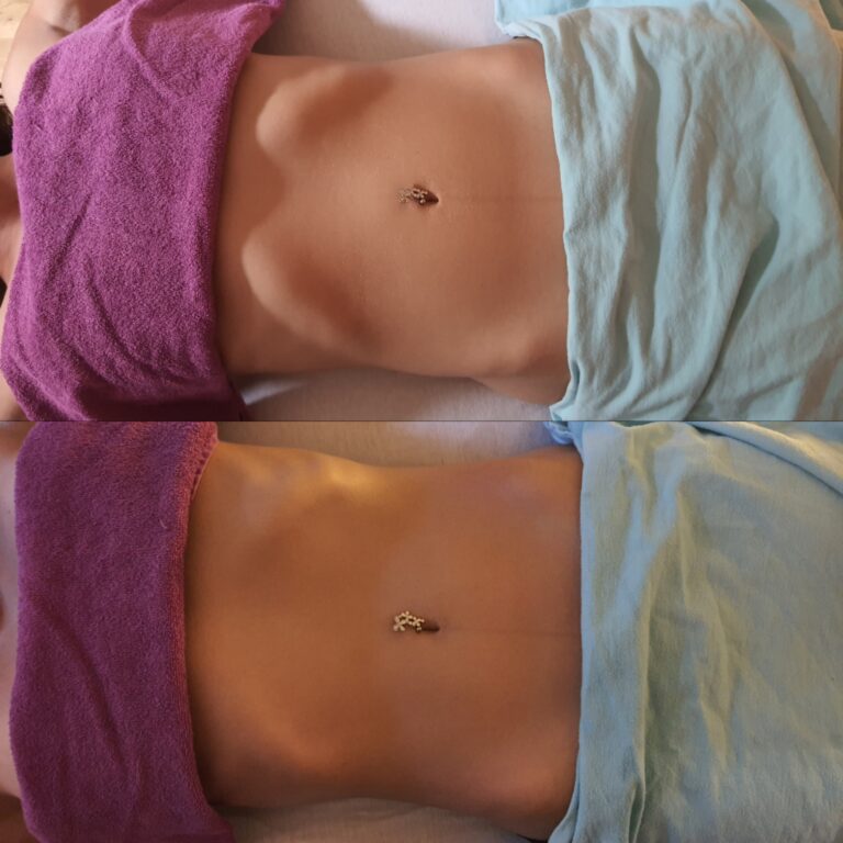 Mehr über den Artikel erfahren Brasilianische Lymphdrainage in München – was bringt sie wirklich?