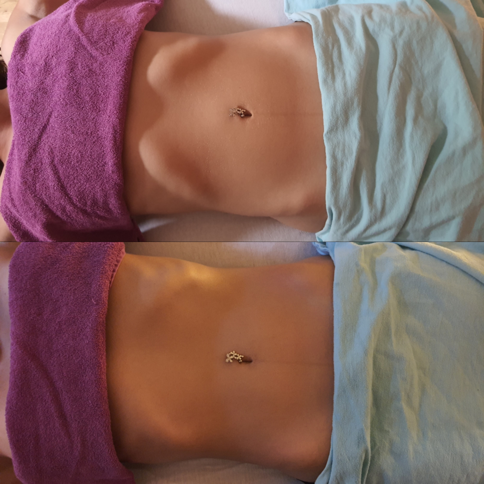 Brasilianische Lymphdrainage in München Vorhher Nachher